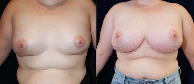 Breast Augmentation Before & After Gallery - Patient 47118719 - Image 1
