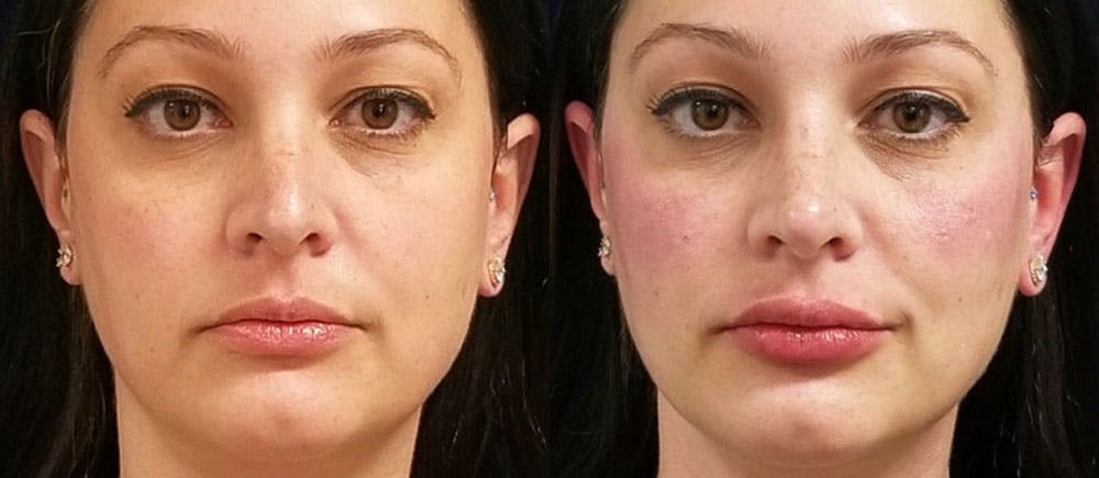Lip Filler Before & After Gallery - Patient 87151477 - Image 1