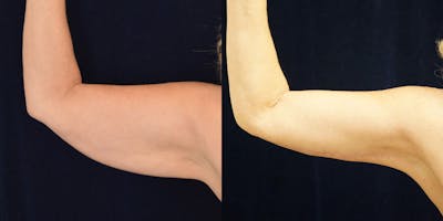 Brachioplasty (Arm Lift) Before & After Gallery - Patient 87151619 - Image 1