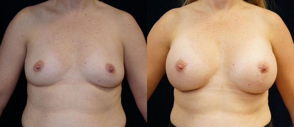 Breast Augmentation Before & After Gallery - Patient 87845649 - Image 1