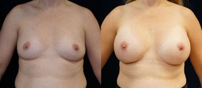 Breast Augmentation Before & After Gallery - Patient 87845649 - Image 1