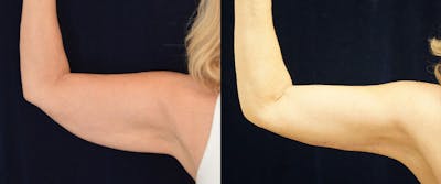 Brachioplasty (Arm Lift) Before & After Gallery - Patient 87850957 - Image 1