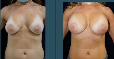 Breast Augmentation Before & After Gallery - Patient 140840916 - Image 1