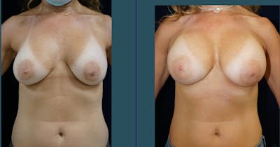 Breast Lift Gallery - Patient 140840947 - Image 1