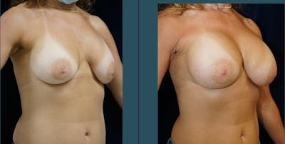 Breast Augmentation Gallery - Patient 140840916 - Image 4