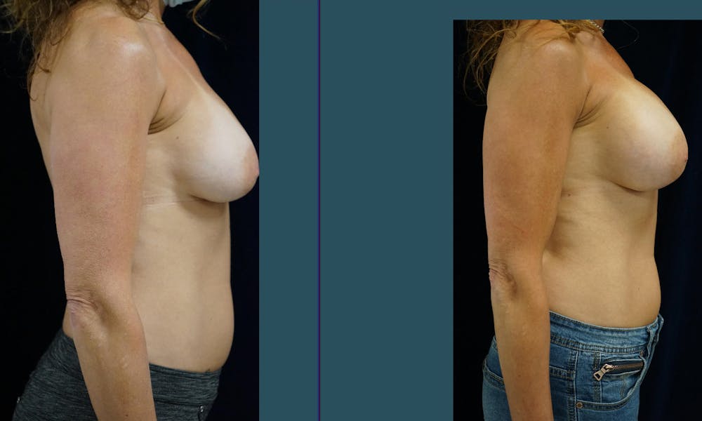 Breast Augmentation Gallery - Patient 140840916 - Image 5