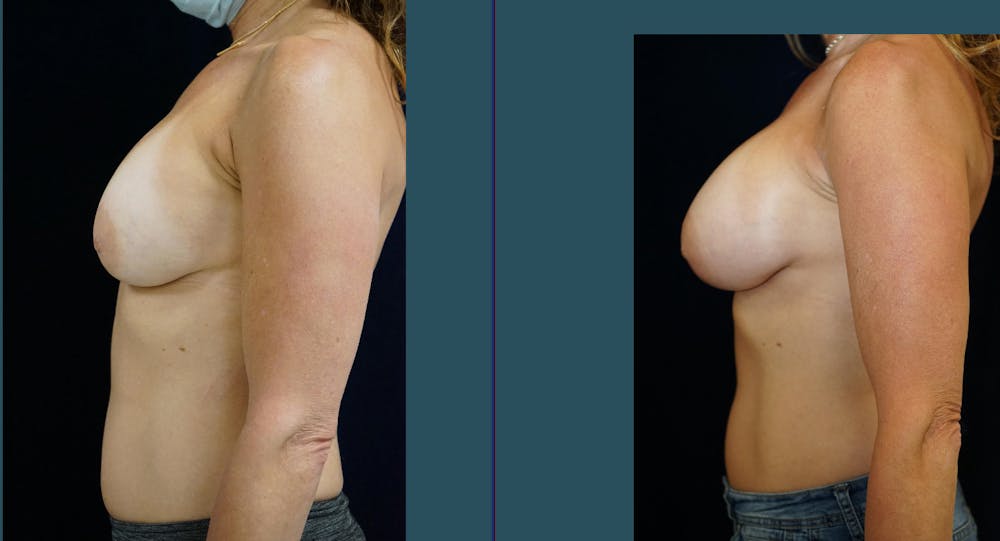 Breast Augmentation Gallery - Patient 140840916 - Image 3