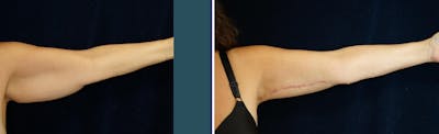 Brachioplasty (Arm Lift) Before & After Gallery - Patient 140840957 - Image 1