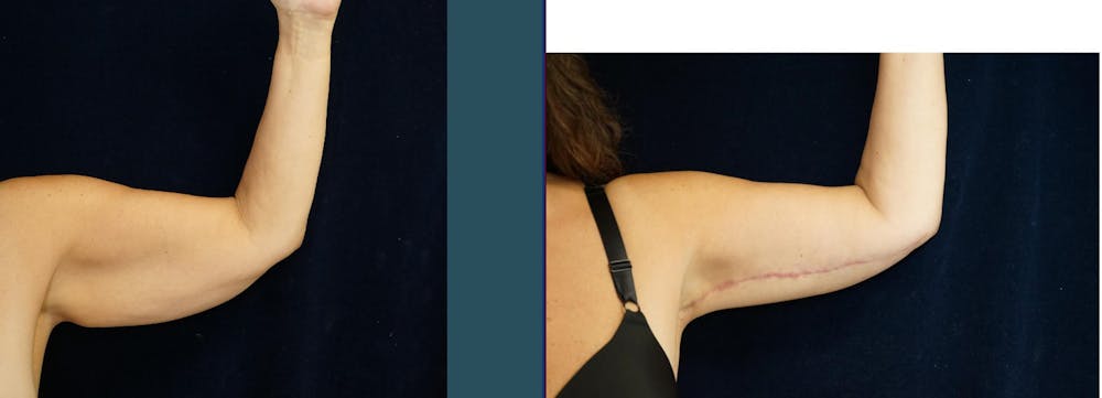 Brachioplasty (Arm Lift) Before & After Gallery - Patient 140840957 - Image 2