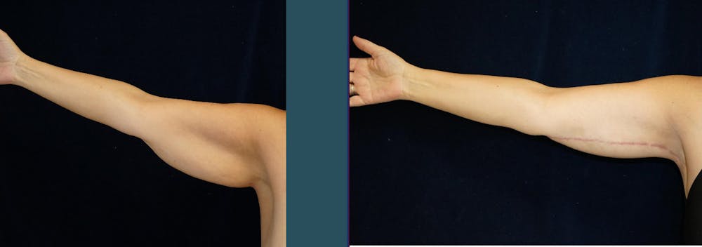 Brachioplasty (Arm Lift) Before & After Gallery - Patient 140840957 - Image 3