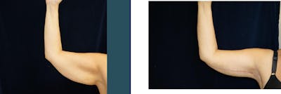 Brachioplasty (Arm Lift) Before & After Gallery - Patient 140840957 - Image 4