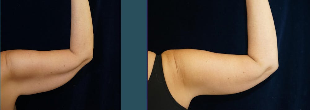 Brachioplasty (Arm Lift) Before & After Gallery - Patient 140840957 - Image 5
