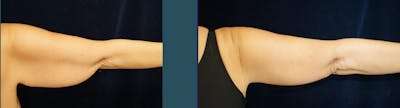 Brachioplasty (Arm Lift) Before & After Gallery - Patient 140840957 - Image 6