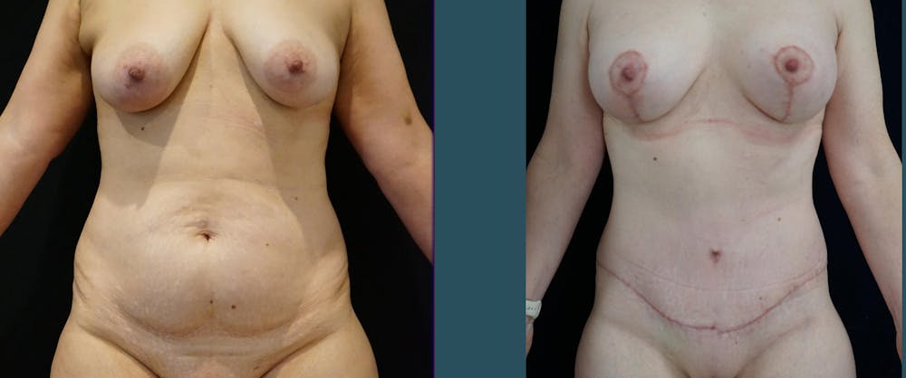 Mommy Makeover Before & After Gallery - Patient 140840973 - Image 1
