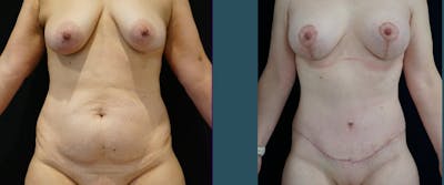 Breast Lift Gallery - Patient 140840980 - Image 1