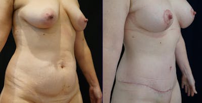 Breast Augmentation Before & After Gallery - Patient 140840976 - Image 2