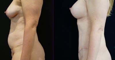 Breast Lift Before & After Gallery - Patient 140840980 - Image 4