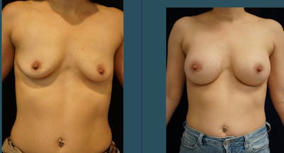 Breast Augmentation Before & After Gallery - Patient 140841177 - Image 1
