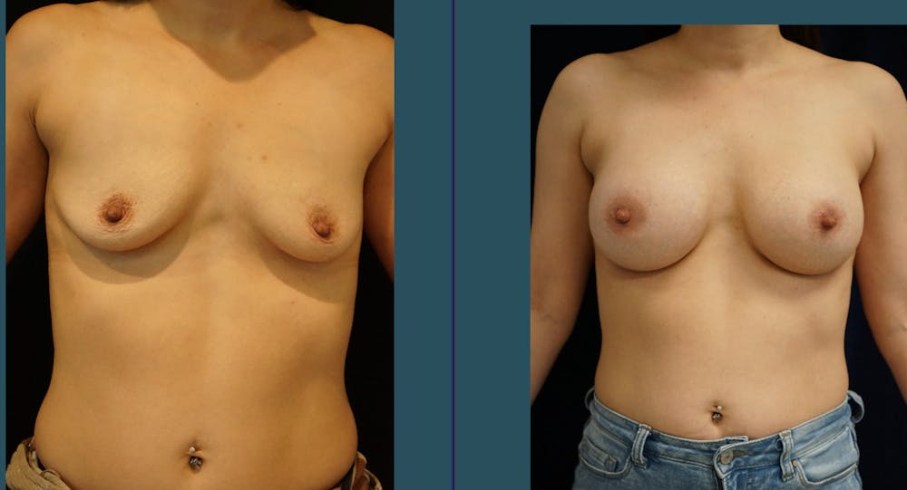 Breast Augmentation Before & After Gallery - Patient 140841177 - Image 1