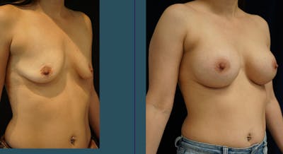 Breast Augmentation Before & After Gallery - Patient 140841177 - Image 2