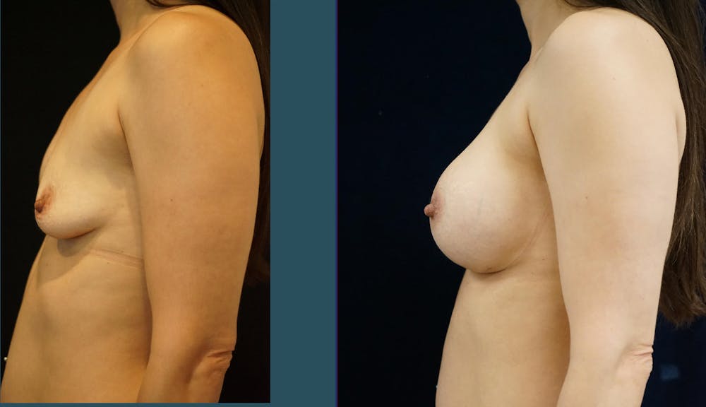 Breast Augmentation Gallery - Patient 140841177 - Image 5