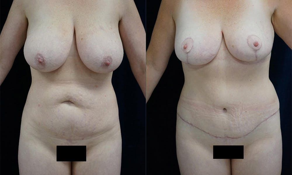 Mommy makeover procedure before and after 1