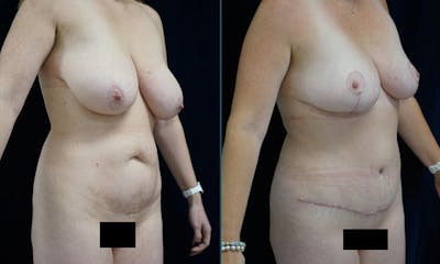 Mommy Makeover Before & After Gallery - Patient 141067920 - Image 2