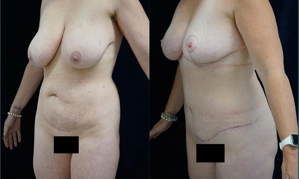 Mommy Makeover Before & After Gallery - Patient 141067920 - Image 4