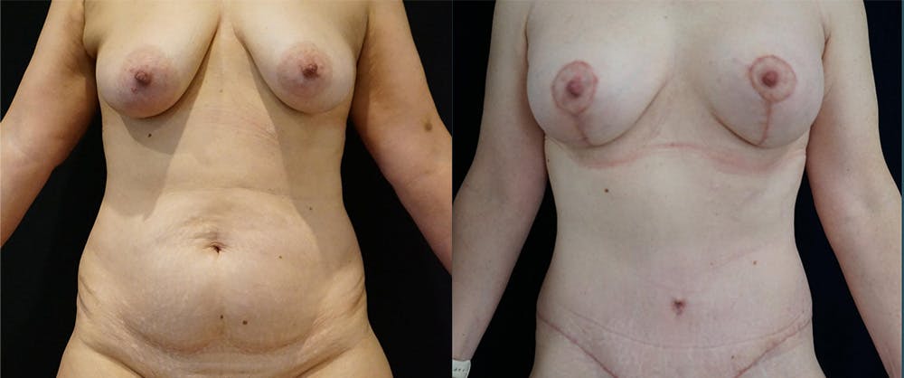 Abdominoplasty Before & After Gallery - Patient 140840975 - Image 4