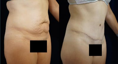 Abdominoplasty Before & After Gallery - Patient 146895 - Image 2