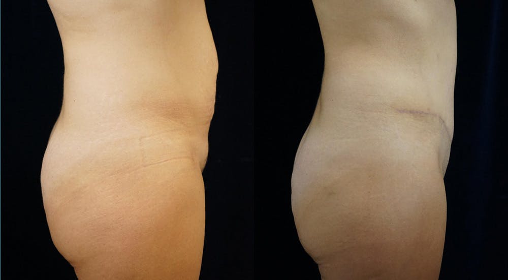 Abdominoplasty Before & After Gallery - Patient 146895 - Image 3
