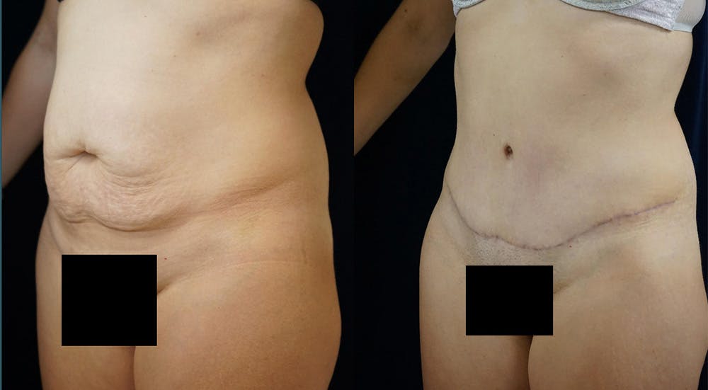 Abdominoplasty Before & After Gallery - Patient 141067919 - Image 4