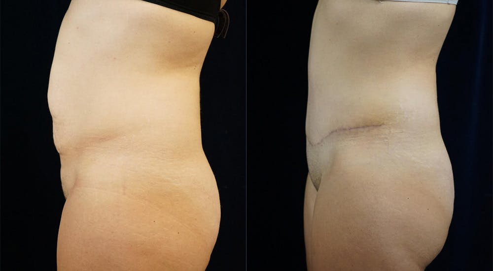 Abdominoplasty Before & After Gallery - Patient 146895 - Image 5