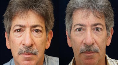Blepharoplasty Before & After Gallery - Patient 775836 - Image 1