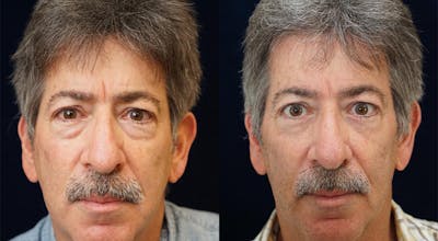 Blepharoplasty Before & After Gallery - Patient 141067930 - Image 1