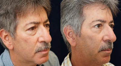 Blepharoplasty Before & After Gallery - Patient 775836 - Image 2