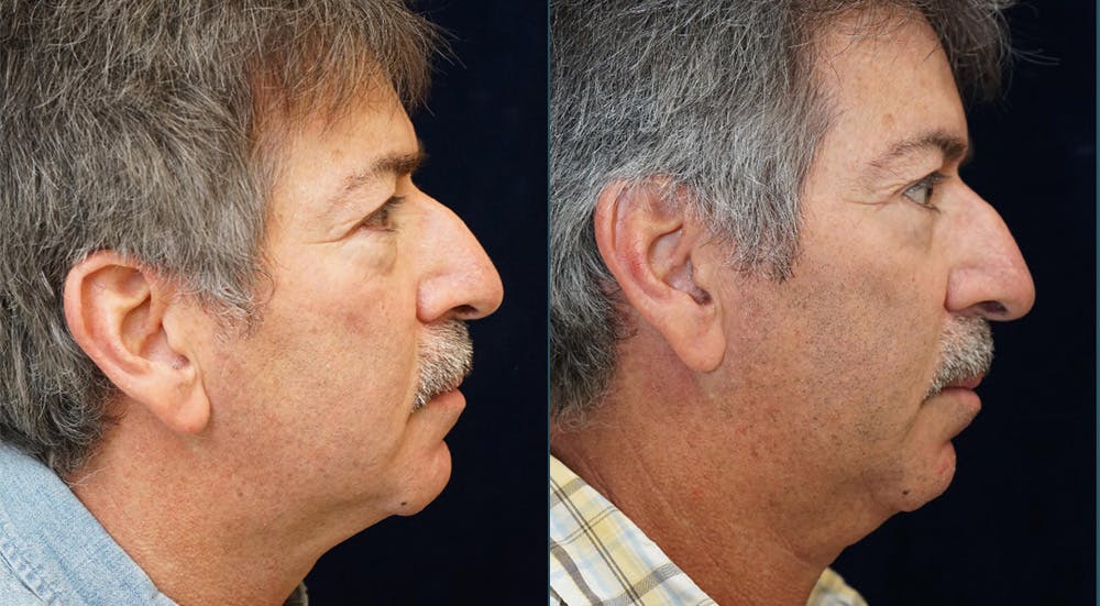 Blepharoplasty Before & After Gallery - Patient 775836 - Image 3