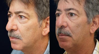 Blepharoplasty Before & After Gallery - Patient 775836 - Image 4