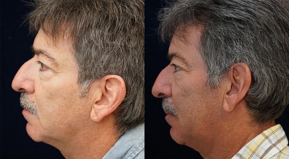 Blepharoplasty Before & After Gallery - Patient 775836 - Image 5