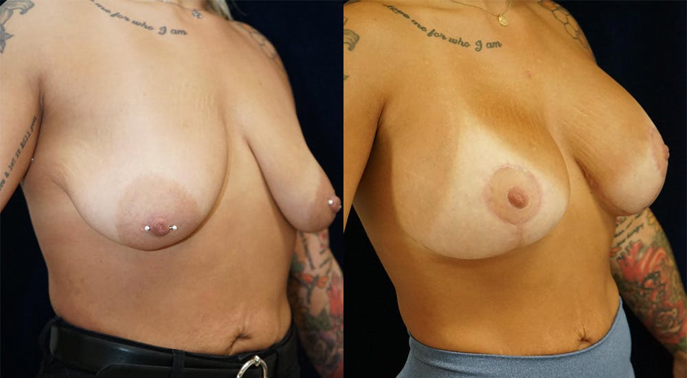 Breast Augmentation Gallery - Patient 141067929 - Image 2