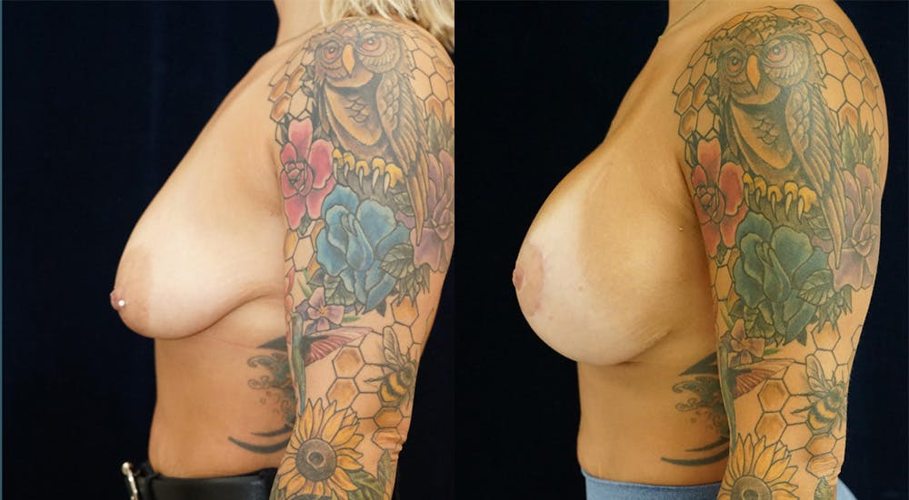 Breast Augmentation Gallery - Patient 141067929 - Image 5