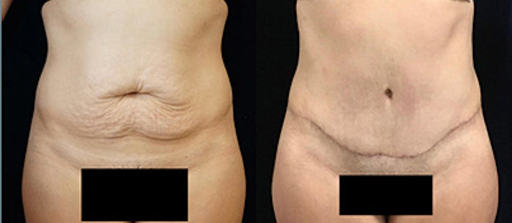 Abdominoplasty Before & After Gallery - Patient 146895 - Image 1