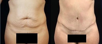 Abdominoplasty Before & After Gallery - Patient 146895 - Image 1
