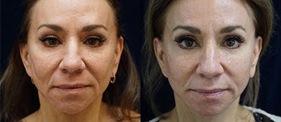 Face Lift Before & After Gallery - Patient 141160075 - Image 1