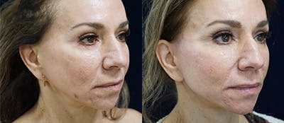 Mini-Facelift Before & After Gallery - Patient 179073 - Image 2