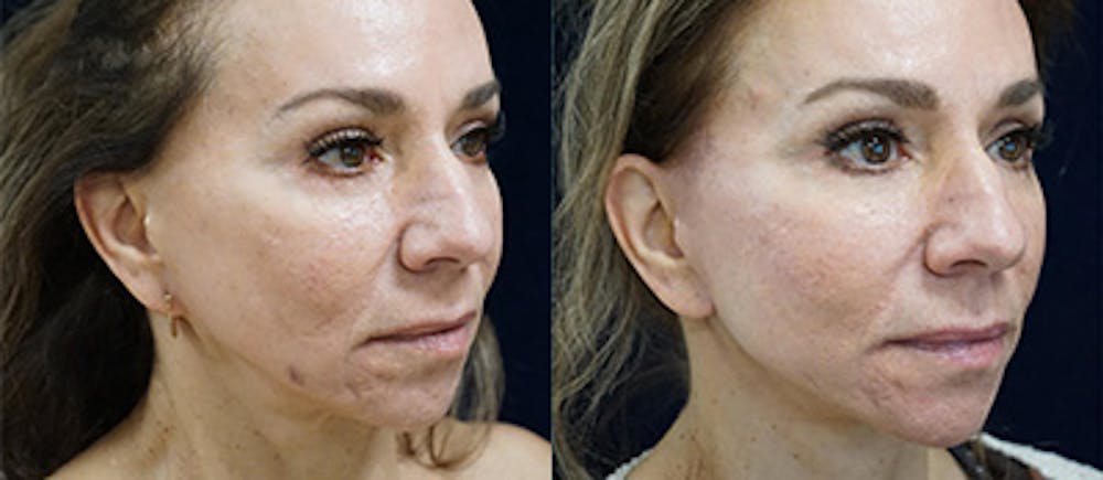 Face Lift Gallery - Patient 141160075 - Image 2