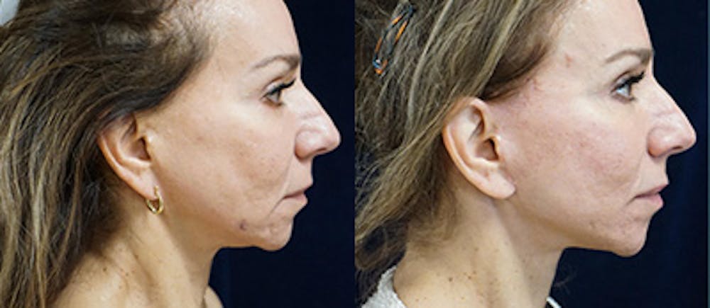 Mini-Facelift Before & After Gallery - Patient 179073 - Image 3