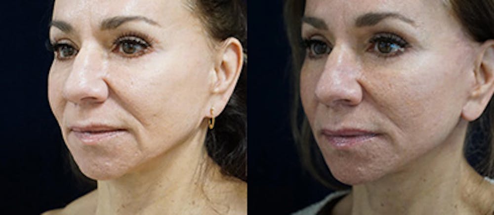 Mini-Facelift Before & After Gallery - Patient 179073 - Image 4