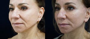 Facelift