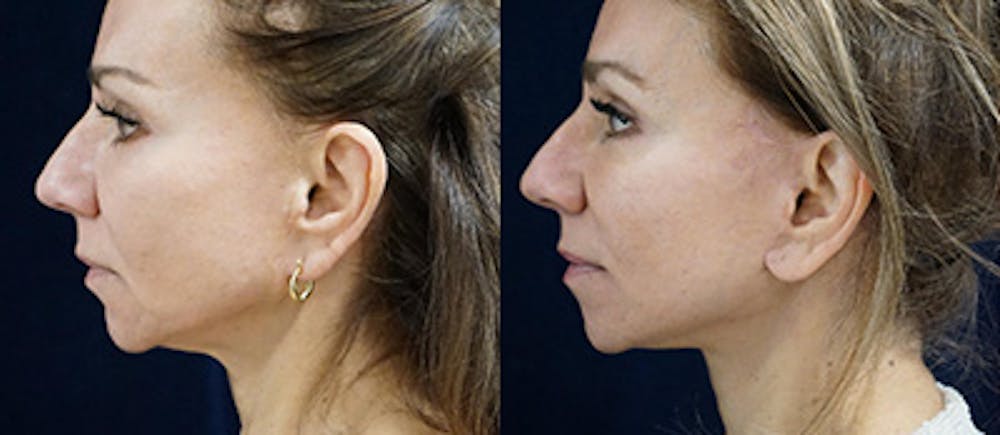 Mini-Facelift Before & After Gallery - Patient 179073 - Image 5
